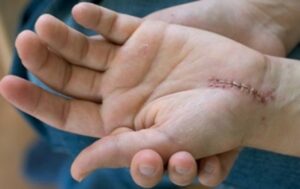 A hand with a scar after having carpal tunnel treatment