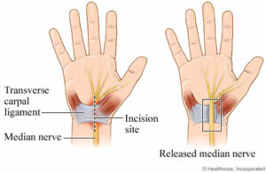 Two hands showing the causes of carpal tunnel syndrome