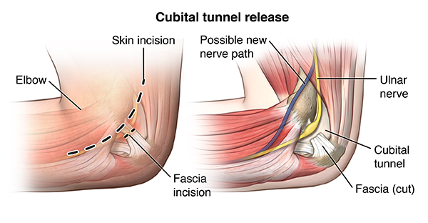 Medical drawing showing the parts of the body that is affected by Cubital tunnel syndrome and its treatment