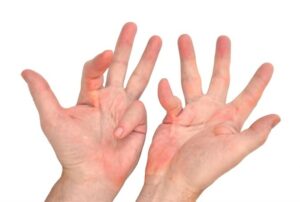 A pair of hands suffering from Dupuytren's disease on Ladan Hajipour .com