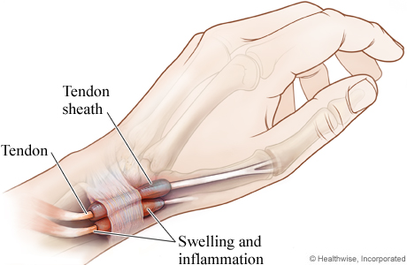 A medical drawing showing the tendons affected by dequervain's disease, and where the treatment will act