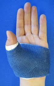 tell if your thumb is sprained