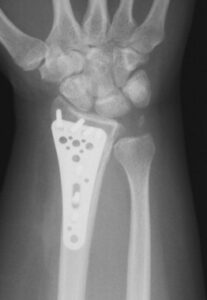 Wrist fracture xray showing operative treatments offered by Ladan Hajipour