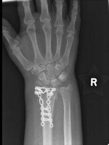 Wrist fracture xray showing operative treatments offered by Ladan Hajipour