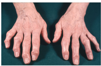 Have I got Finger Arthritis?