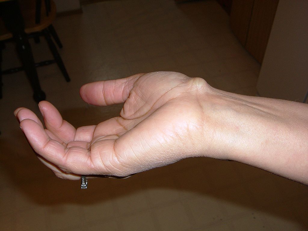Wrist ganglion cyst