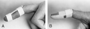 Fingers in a splint during Mallet Finger treatment.