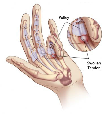 Natural Home Remedies For De Quervain S Tendinitis Of Thumb Natural Home Remedies For De Quervain S Tendinitis Of Thumb