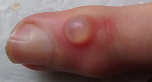 Digital mucous cyst in the finger