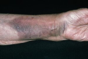 broken wrist nhs - Manchester Hand & Wrist Surgery