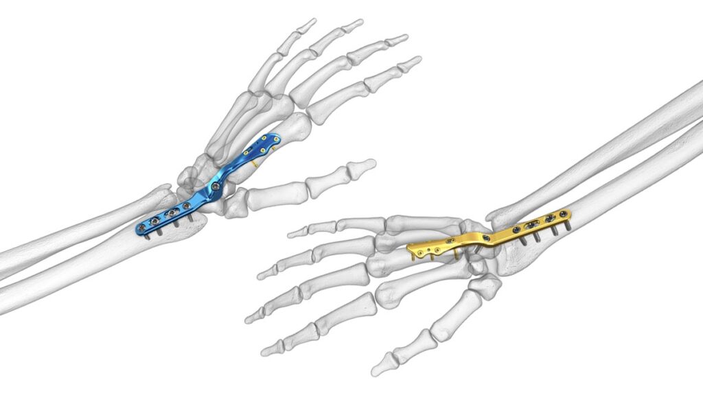 Wrist Fusion Treatment Manchester Hand & Wrist Surgery