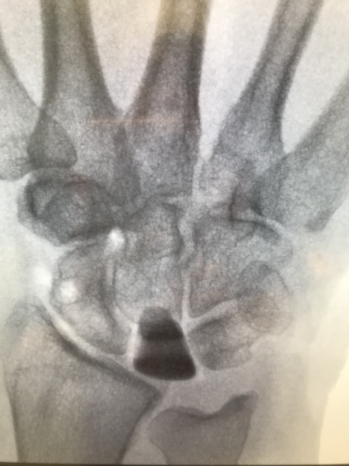Find out more about Kienbocks disease with Ladan Hajipour
