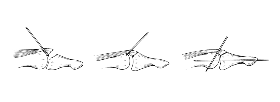 Skeleton sketch of tendons being pinned into place during Mallet finger treatment.